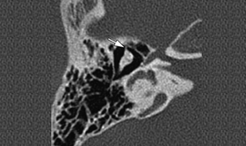 CT HRCT Temporal Bones