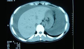 CT Scan of Abdomen